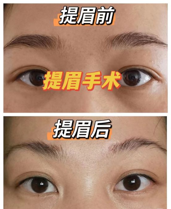 提眉最新技术，塑造美丽轮廓的革命性突破